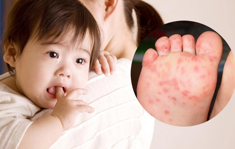 Trẻ bị tay chân miệng nên và không nên ăn gì để mau khỏi? 